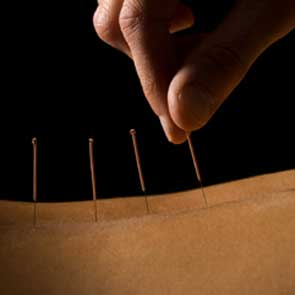 Acupuncture à Repentigny